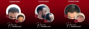 Медицинский туризм в Турции